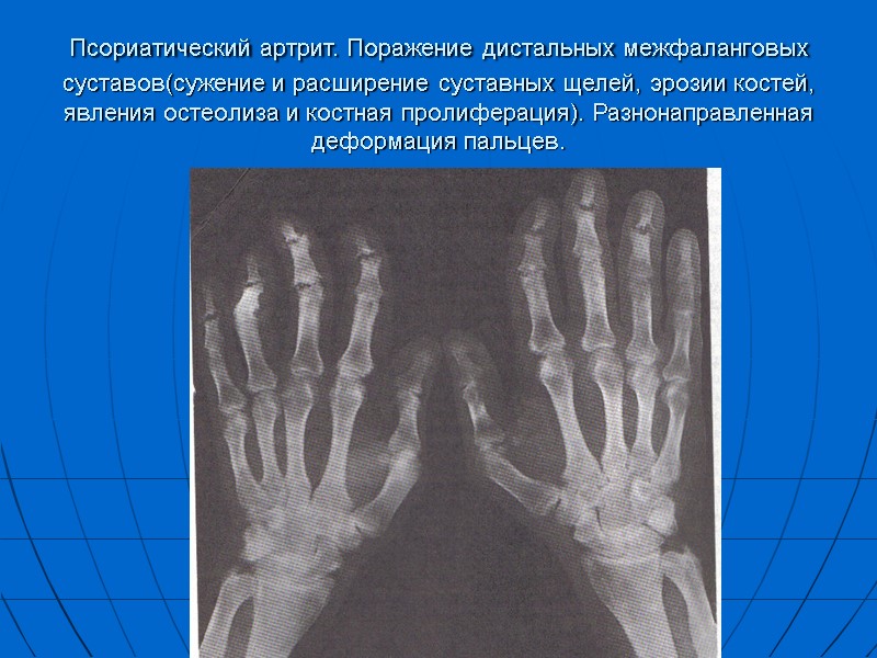 Псориатический артрит. Поражение дистальных межфаланговых суставов(сужение и расширение суставных щелей, эрозии костей, явления остеолиза